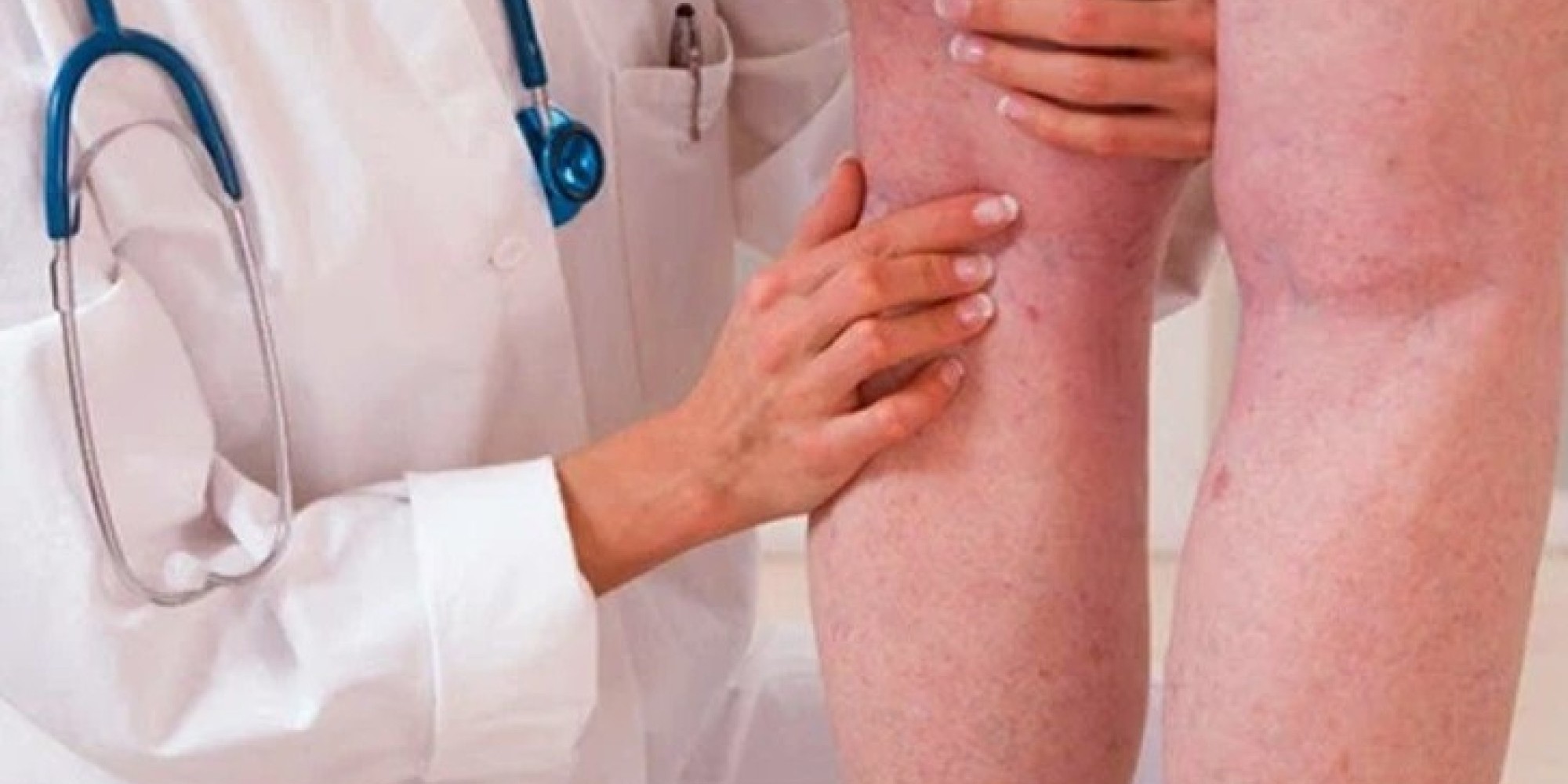 Médicos revelam que a Trombose causa 165 internações diárias no Brasil