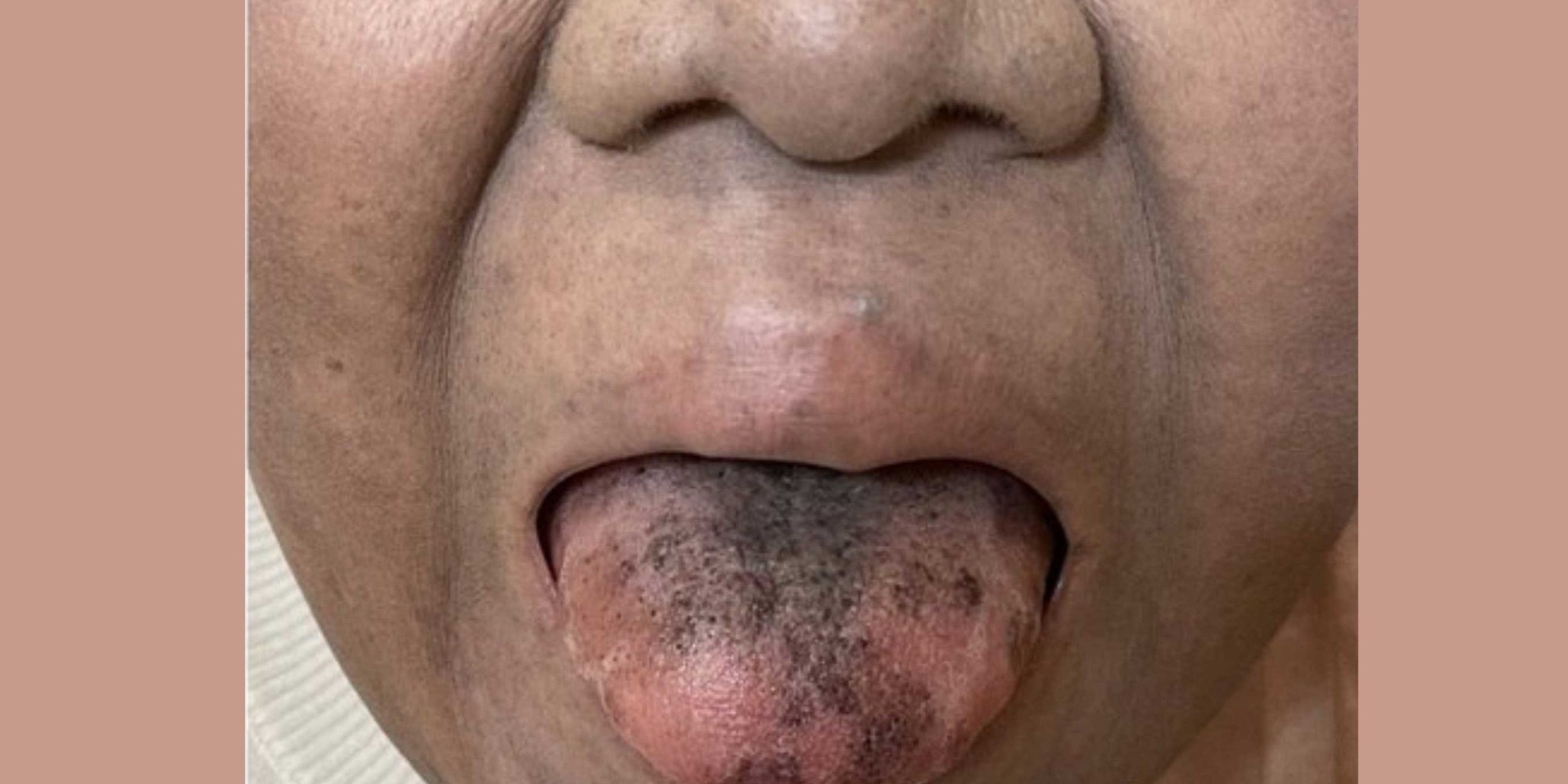 Mulher fica com a língua escura e peluda após tomar antibiótico