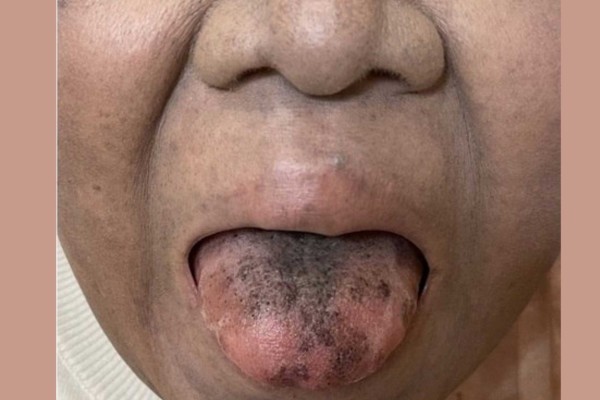 Mulher fica com a língua escura e peluda após tomar antibiótico