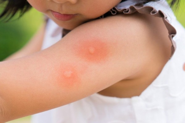 Registrada a terceira morte de criança por dengue no estado