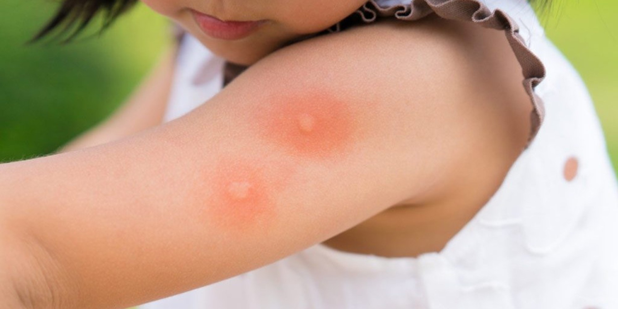 Registrada a terceira morte de criança por dengue no estado