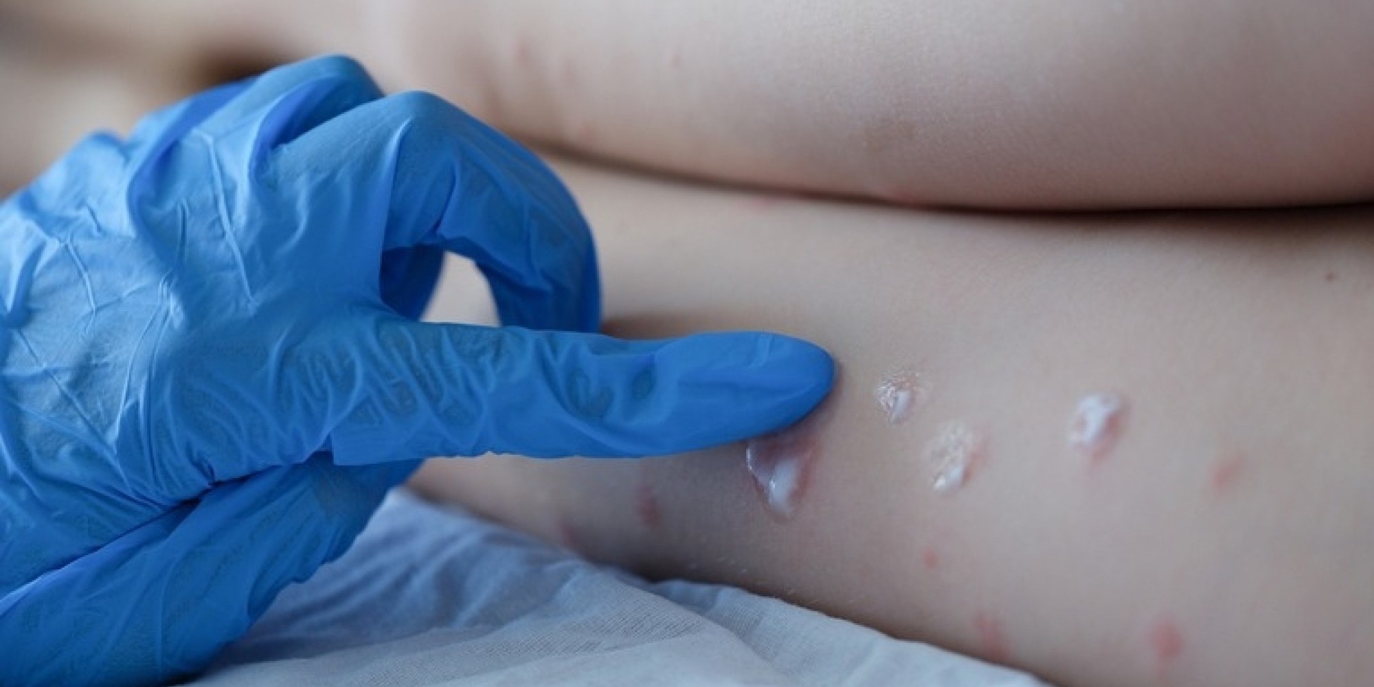 Especialistas fazem alerta sobre a disseminação da varíola dos macacos