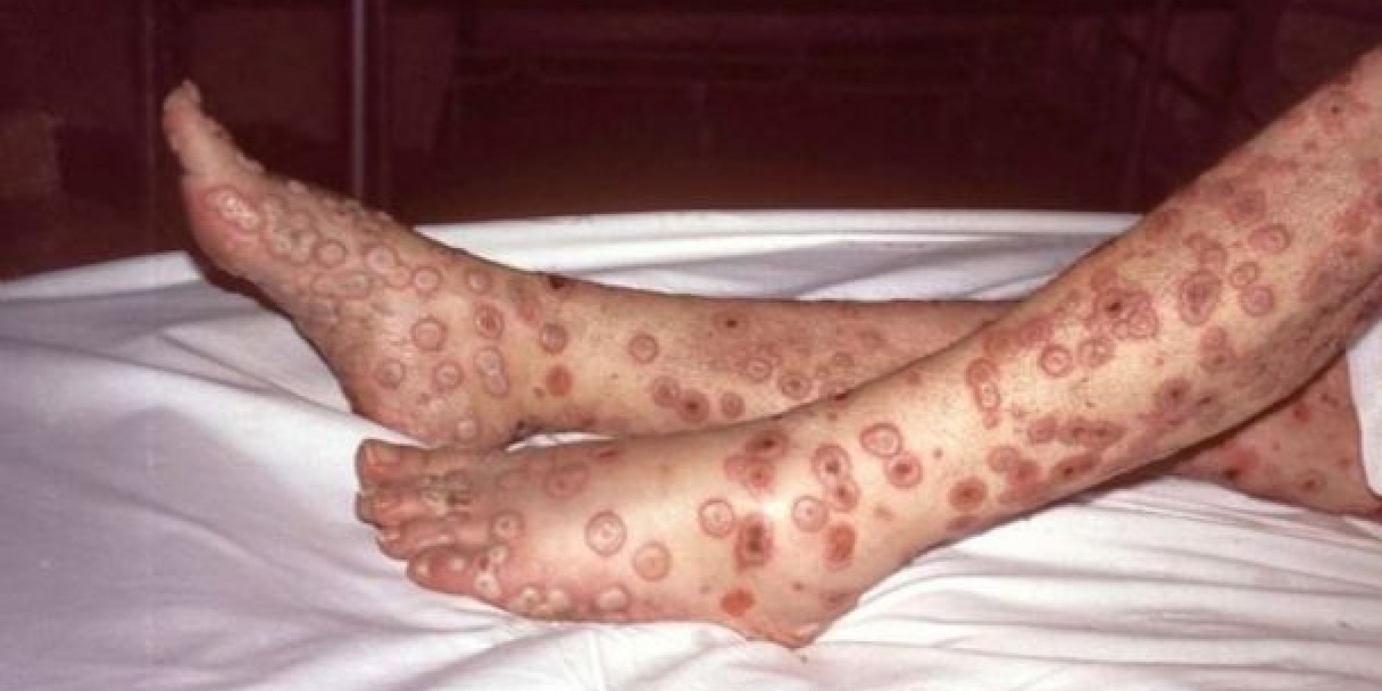 RS confirma 2º caso de varíola dos macacos