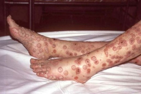 RS confirma 2º caso de varíola dos macacos