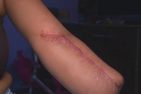 Mulher tem a mão amputada após parto