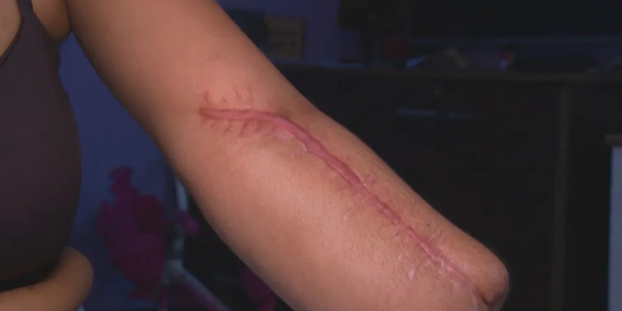 Mulher tem a mão amputada após parto