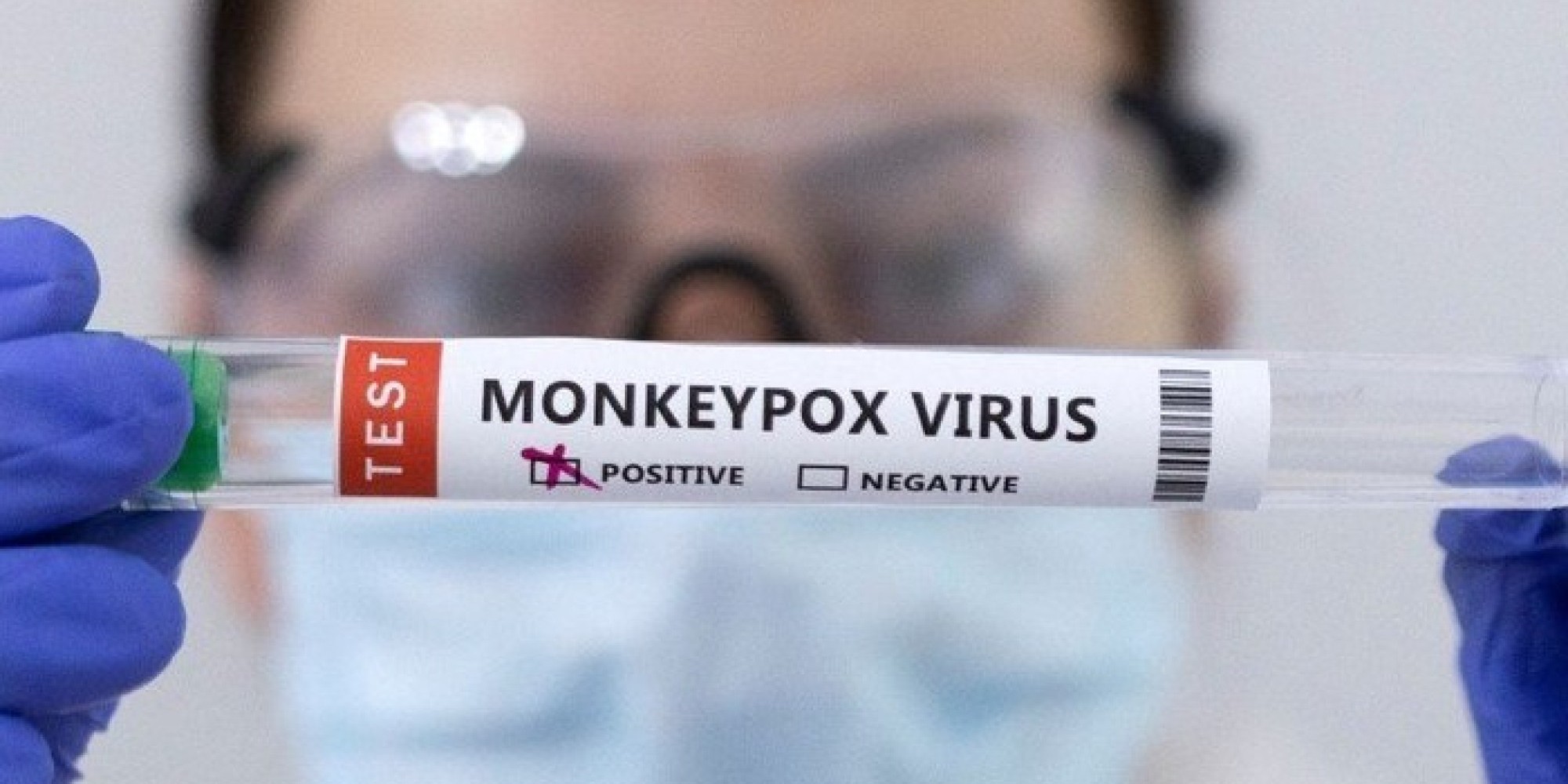 Garibaldi tem o primeiro caso de varíola dos macacos