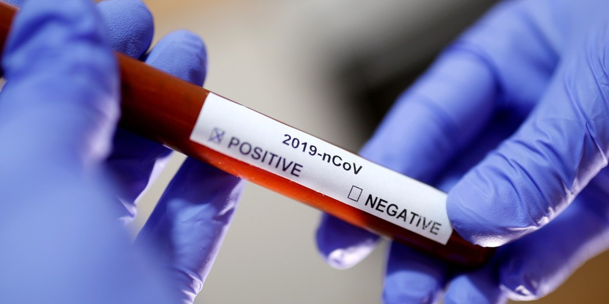 Casos confirmados no Brasil chegam a 20