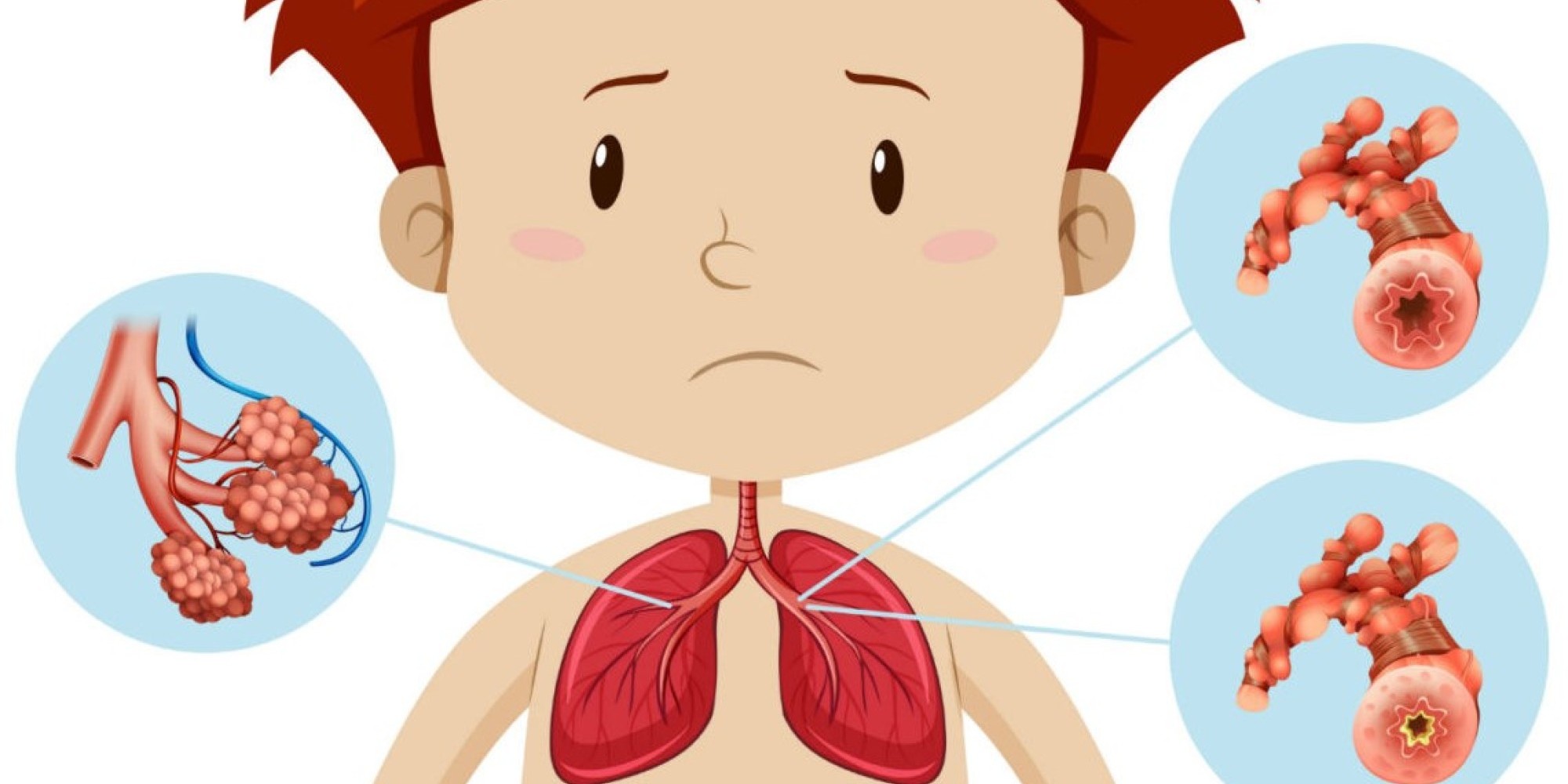 Bronquiolite: da infecção pelo vírus sincicial respiratório à falta de ar em crianças