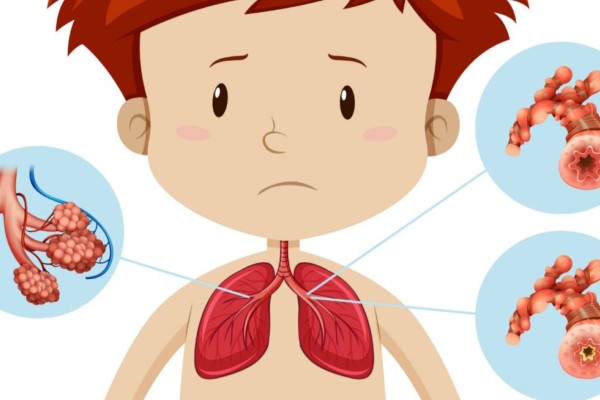 Bronquiolite: da infecção pelo vírus sincicial respiratório à falta de ar em crianças