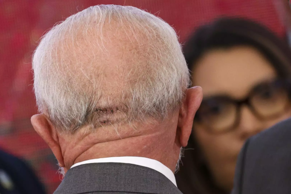 Lula remove pontos na cabeça após acidente doméstico